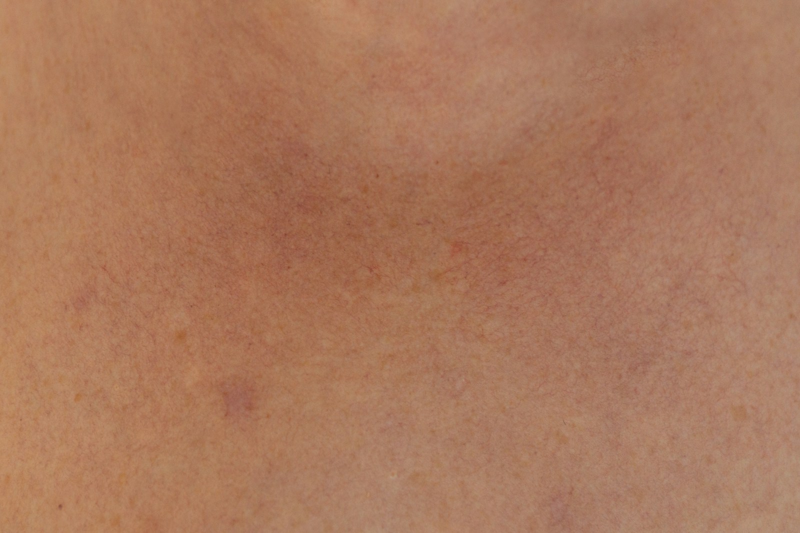 Beef Tallow for Rosacea: What the Evidence Says